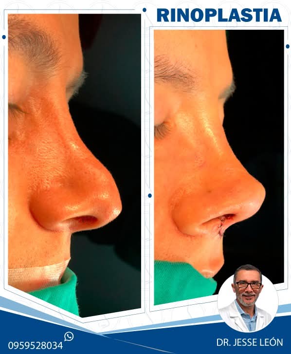 Rinoplastia antes y después